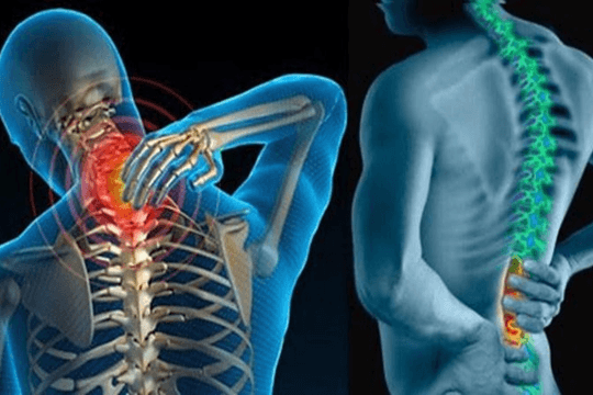 Gai cột sống có nguy hiểm không?