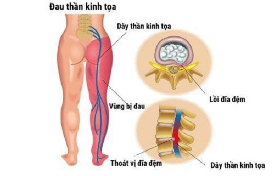 Tìm hiểu về căn bệnh đau thần kinh tọa