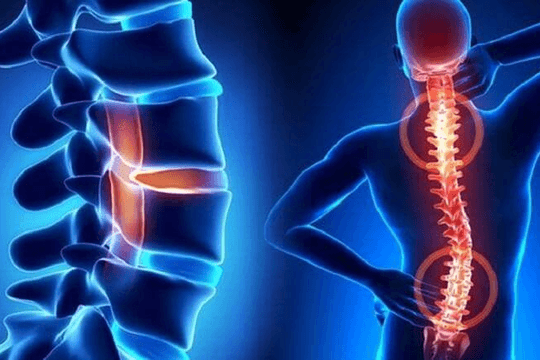 Những điều cần biết về bệnh thoái hóa cột sống