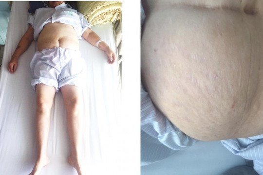 Suy tuyến thượng thận vì lạm dụng corticoid