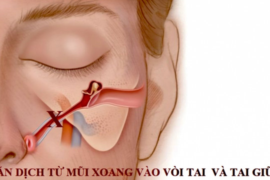 Ù tai khi bị viêm mũi xoang