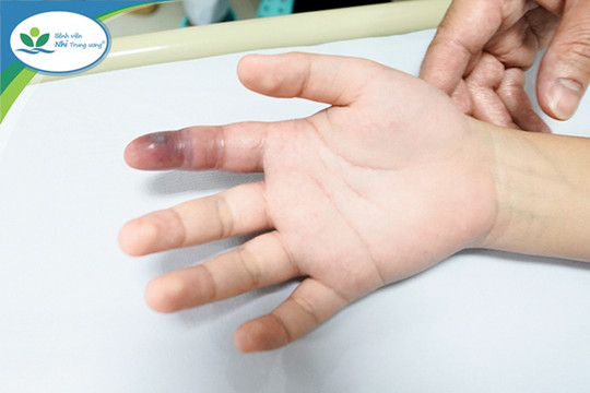 Lén nuôi rắn làm thú cưng, bé trai 13 tuổi bị cắn nguy hiểm tới tính mạng