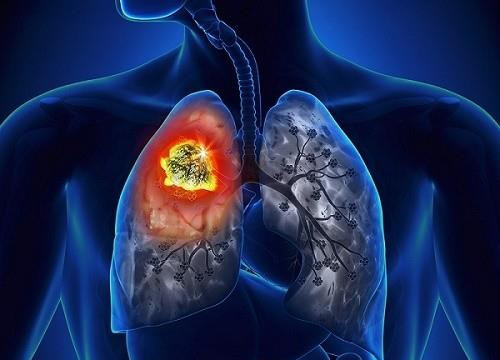 Nếu có 5 dấu hiệu này chứng tỏ phổi của bạn không khỏe, hãy sớm đi kiểm tra