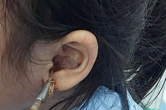 Cấp cứu bé gái bị dị vật xuyên ống tai kẹt vào hòm nhĩ
