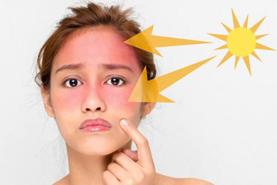 4 nhóm người cực kỳ dễ cháy nắng, thậm chí cả khi mát trời