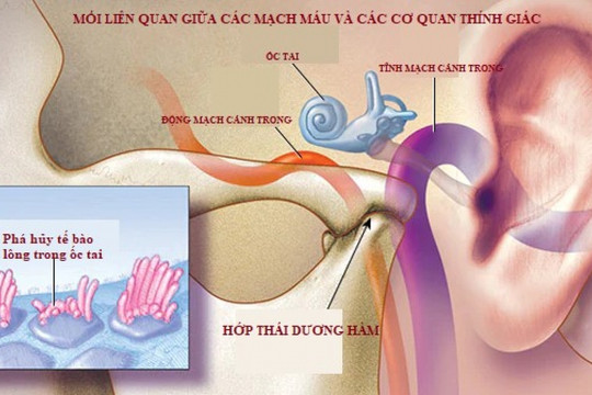 Ù tai có thể là chỉ dấu báo trước về bệnh tim mạch nguy hiểm