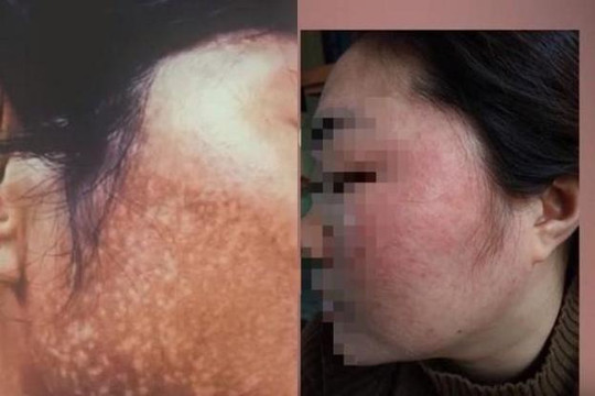 Phát hiện mẫu kem chuyên nám có hàm lượng thủy ngân vượt mức
