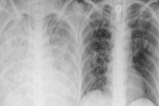 Lạm dụng corticoid tự điều trị cúm, người phụ nữ viêm phổi, suy đa tạng