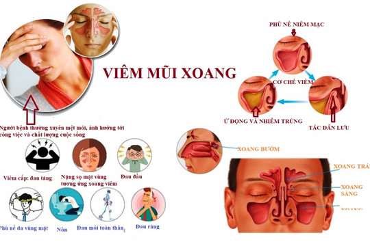 Các thói quen xấu dễ dẫn đến viêm mũi xoang