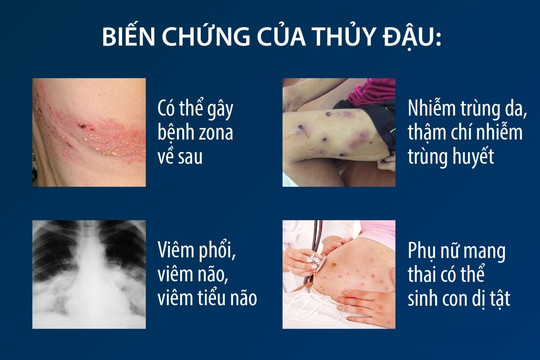 Bệnh thủy đậu bùng phát ở Hà Nội: Chuyên gia khuyến cáo cách phòng bệnh