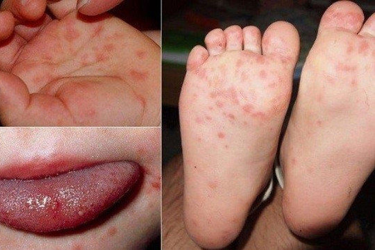 Bộ Y tế đã tìm được nguồn cung thuốc điều trị bệnh tay chân miệng