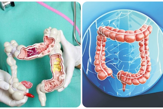 7 dấu hiệu ung thư đại tràng giai đoạn đầu dễ nhận biết nhất