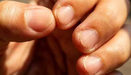 5 dấu hiệu bất thường trên móng tay tuyệt đối không coi nhẹ