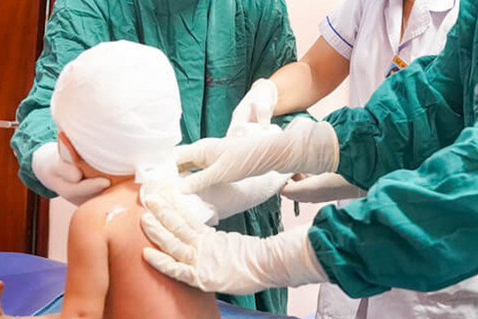 Bé ngã vào bát canh nóng, bôi mỡ trăn khiến bỏng càng nặng: Bác sĩ cảnh báo
