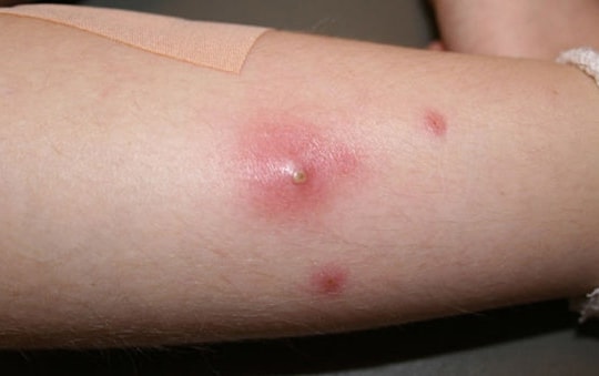 Nhiễm khuẩn tụ cầu vàng nguy hiểm như thế nào?