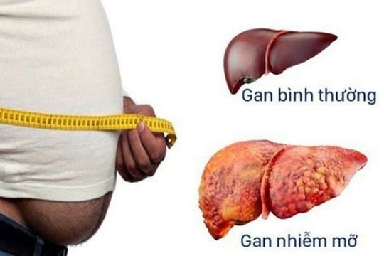 Người bị gan nhiễm mỡ bao lâu nên đi khám một lần?