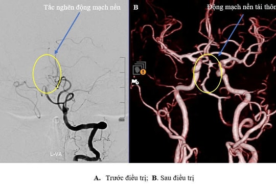 Kỳ tích cứu sống bệnh nhân đột quỵ não đã qua giờ vàng