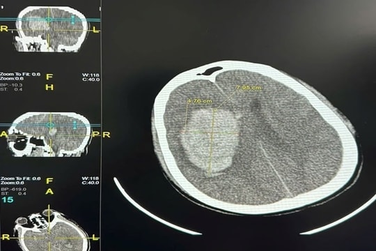 Số ca đột quỵ do tắm khuya gia tăng