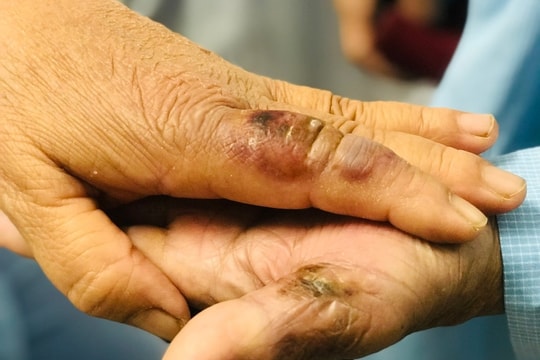 Bị chuột cắn vào tay, hai vợ chồng nhập viện