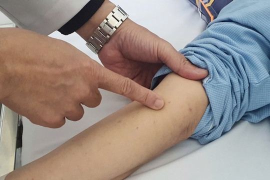 Sốt rét, nổi ban hoại tử, người phụ nữ nguy kịch vì nhiễm não mô cầu