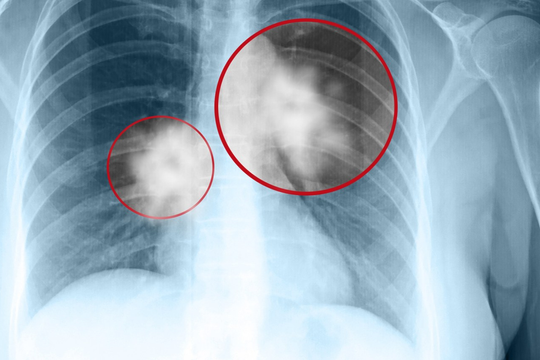 9 dấu hiệu ung thư phổi giai đoạn đầu bạn không nên bỏ qua