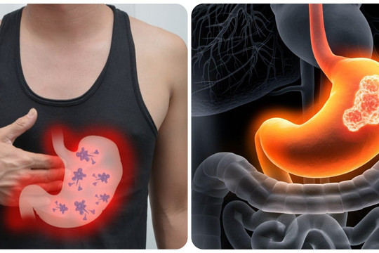 6 triệu chứng ung thư dạ dày giai đoạn đầu