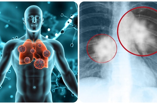 8 dấu hiệu cảnh báo ung thư phổi không nên bỏ qua