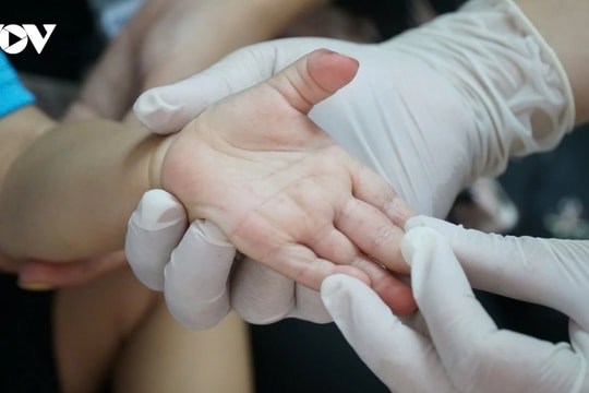 Cẩn trọng với bệnh tay chân miệng khi thời tiết chuyển mùa