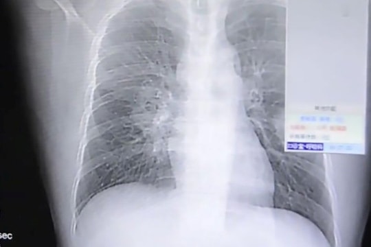 Người đàn ông nhập viện vì nhiễm trùng phổi, bác sĩ chỉ ra một thói quen tai hại