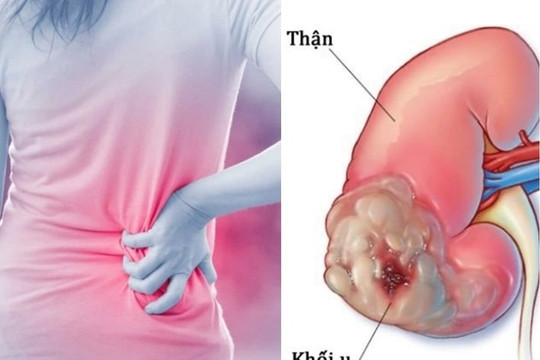 Những dấu hiệu âm thầm của ung thư thận dễ bị bỏ qua
