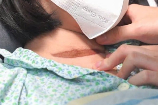 Bé gái ngừng tim, phù phổi vì bị cửa cuốn kẹp cổ