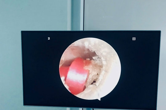Bé gái 6 tuổi suýt thủng màng nhĩ vì... một sợi dây buộc tóc
