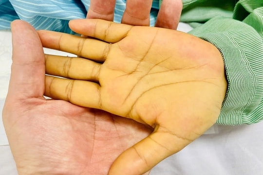 Sụt cân, mệt mỏi - cảnh báo sớm của ung thư gan ít ai ngờ