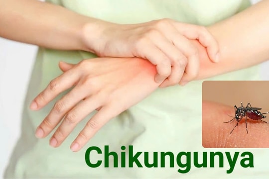 Nhóm người nguy cơ mắc bệnh Chikungunya
