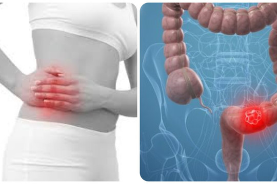 8 dấu hiệu ung thư đại tràng tuyệt đối không nên bỏ qua