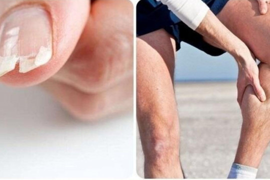 Dấu hiệu cảnh báo cơ thể đang thiếu canxi hay bị nhiều người bỏ qua