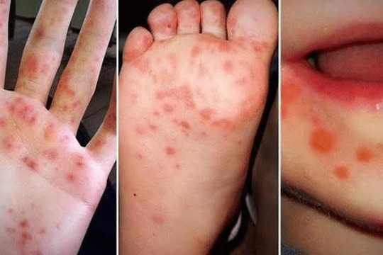 Bệnh tay chân miệng: Số ca bệnh nặng có thể tiếp tục gia tăng