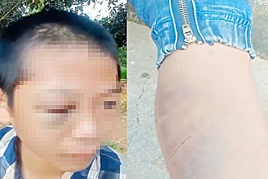Công an vào cuộc xác minh vụ bé trai lớp 6 ở Nghệ An nghi bị bạo hành