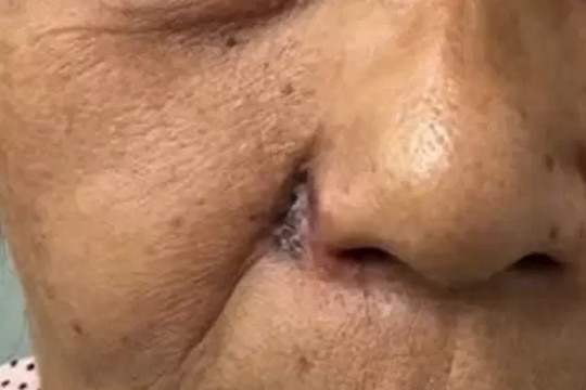 Tưởng nốt ruồi thông thường, người phụ nữ bị ung thư phá hủy toàn bộ cánh mũi