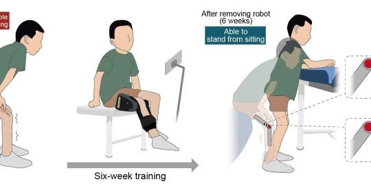 Trung Quốc phát triển robot đeo hỗ trợ trẻ mắc teo cơ tủy sống phục hồi vận động