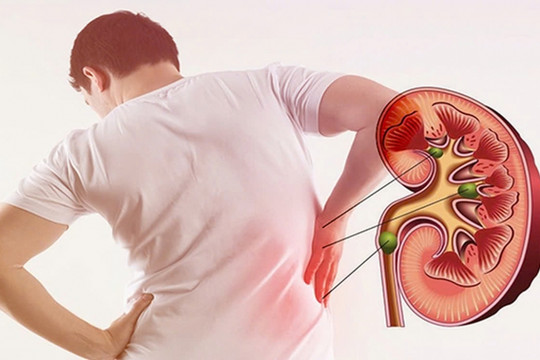 Dân văn phòng cũng có nguy cơ cao mắc sỏi thận mùa nắng nóng