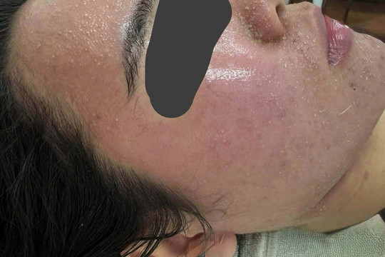 Mặt sưng phù, nổi kín mụn sau vài lần dùng mỹ phẩm dưỡng trắng trên mạng