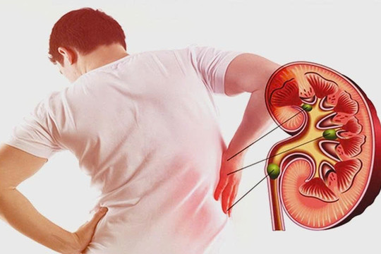 3 nhóm người có nguy cơ suy thận cao nhưng thường chủ quan