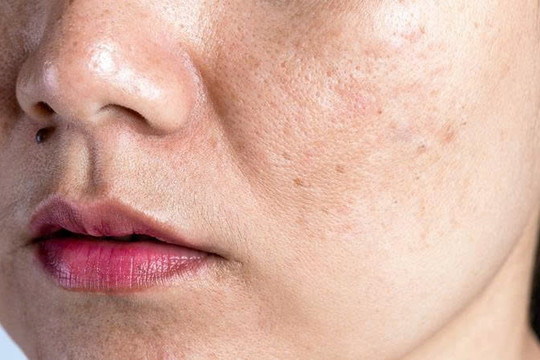 5 sai lầm mỗi ngày khiến da dễ nám hơn, nhiều chị em vẫn vô tình mắc