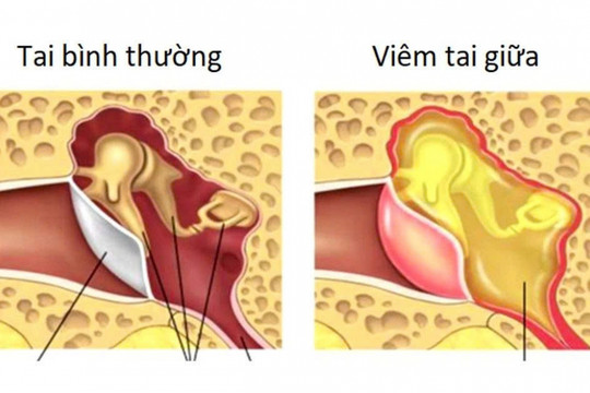 Đau tai, ù tai chớ chủ quan: Nhận biết 3 dạng viêm tai thường gặp