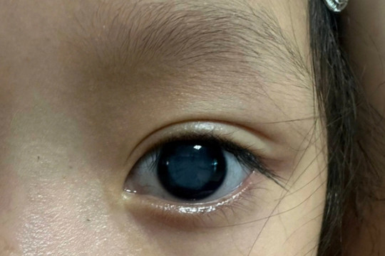 Mắt con có vẻ lệch, có phải trẻ bị lác?